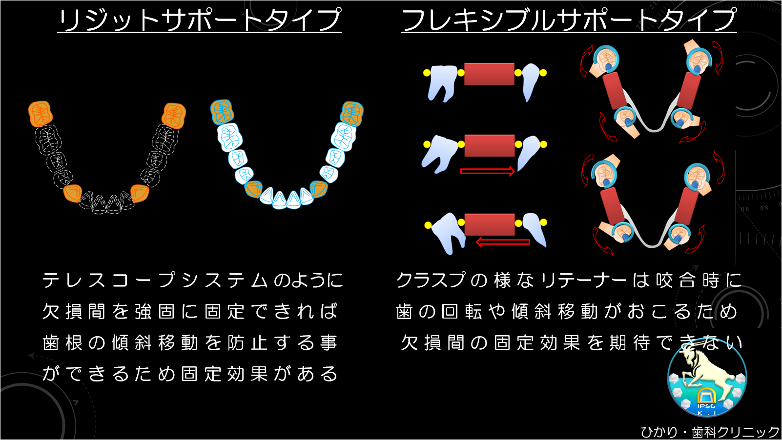 部分入れ歯が安定するために、力学的な分析やそれを維持するための方