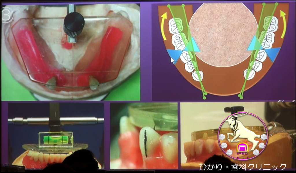 生体に優しい総義歯製作法 高維持力機能総義歯+borbonrodriguez.com