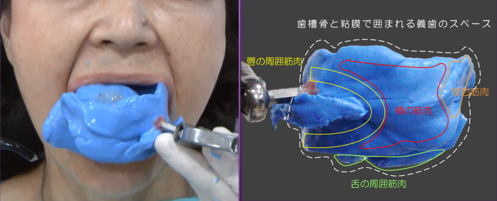 上下顎同時印象法による総入れ歯制作