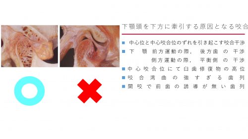 顎関節症の発症原因になる咬合について５