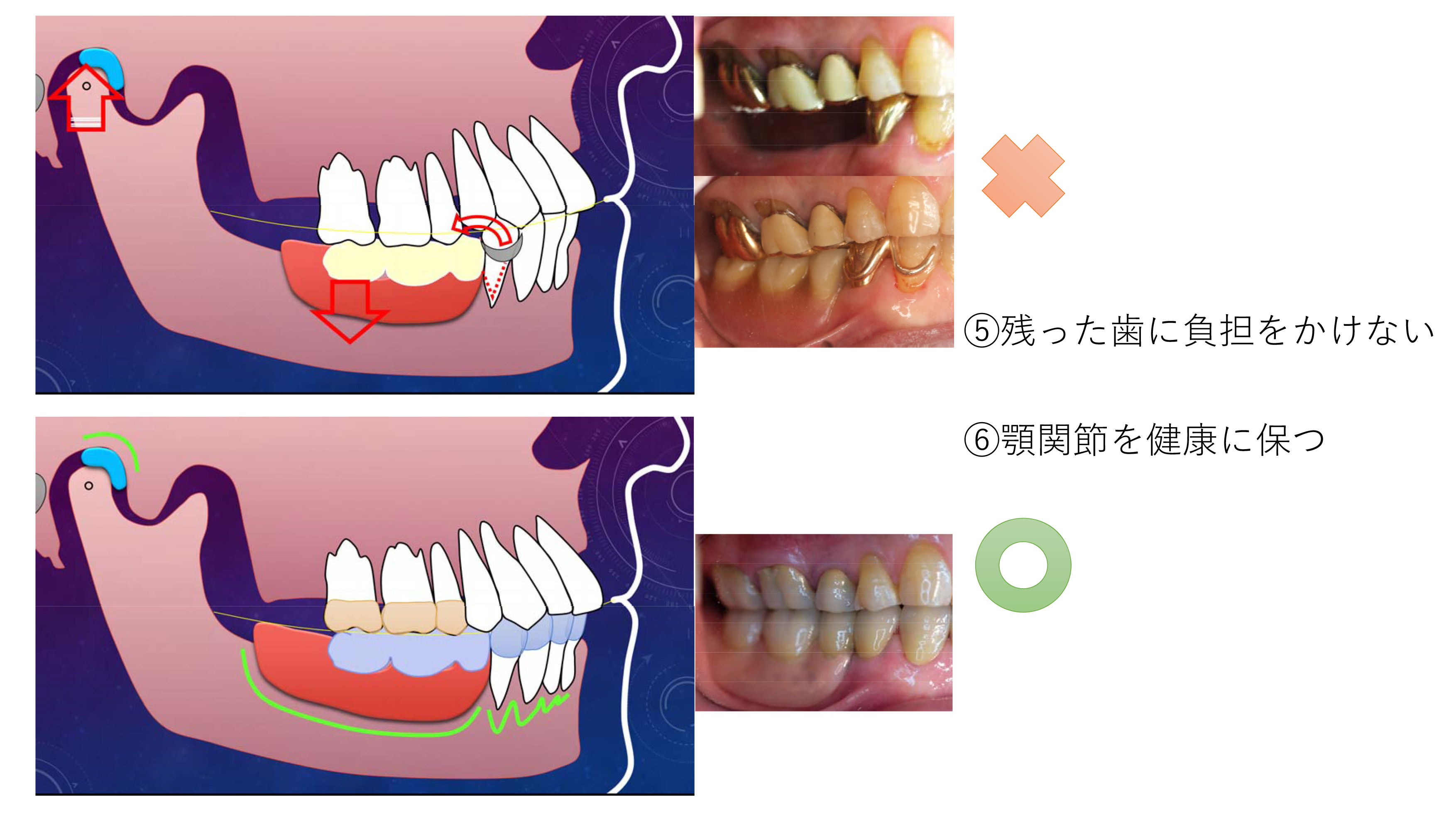 入れ歯と咬み合わせ