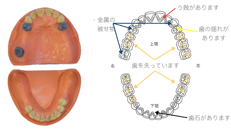 リスク診査では イラストを使ってわかりやすい説明をしております 千葉県松戸市の入れ歯専門歯科医院 ひかり 歯科クリニック