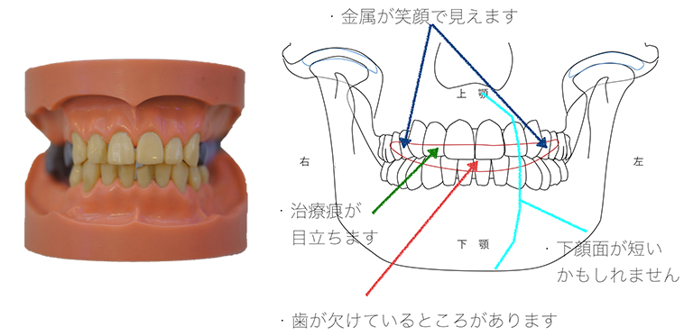 リスク診査では イラストを使ってわかりやすい説明をしております 千葉県松戸市の入れ歯専門歯科医院 ひかり 歯科クリニック