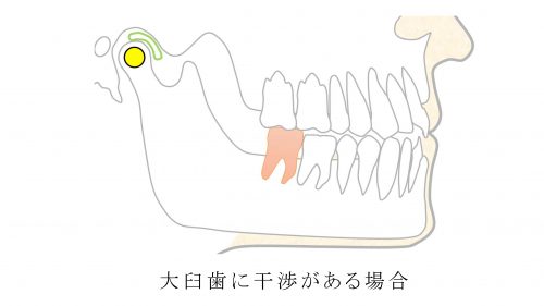 奥歯に干渉がある場合